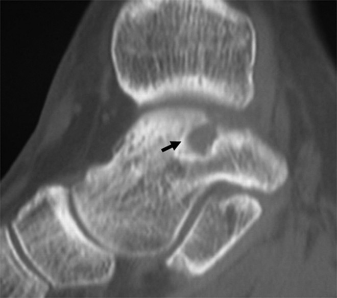 subchondral cyst in the ankle