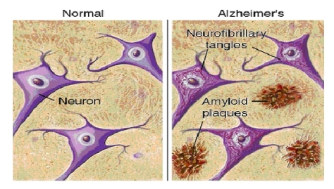 Amyloids and Alzheimer's