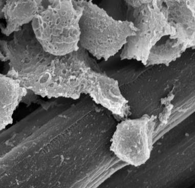 A microscopic view using electron microscopy of human stem cells and viral gene carriers adhering to the fibers of a polymer scaffold.  Photo source:  http://www.pratt.duke.edu/news/gene-therapy-might-grow-replacement-tissue-inside-body.  