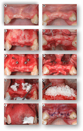 Cell transplantation procedure. Front view (A) and top view (B) of the initial clinical presentation showing severe hard and soft tissue alveolar ridge defects of the upper jaw. Following elevation of a full-thickness gingival flap, the images show front view (C) and top view (D) of the severely deficient alveolar ridge, clinically measuring a width of only 2–4 mm. Front view (E) and top view (F) of the placement of “tenting” screws in preparation of the bony site to receive the graft. Placement of the β-tricalcium phosphate (seeded with the cells 30 minutes prior to placement at room temperature) into the defect (G), with additional application of the cell suspension following placement of the graft in the recipient site (H). Placement of a resorbable barrier membrane (I) to stabilize and contain the graft within the recipient site, and top view (J) of primary closure of the flap.