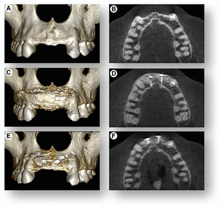 Cone-beam computed tomography (CBCT) scans. CBCT scans were used to render three-dimensional reconstructions of the anterior segment of the upper jaw and cross-sectional (top view) radiographic images to show volumetric changes of the upper jaw at three time points. (A, B): The initial clinical presentation shows 75% jawbone width deficiency. (C, D): Immediately following cell therapy grafting, there is full restoration of jawbone width. (E, F): Images show 25% resorption of graft at 4 months and overall net 80% regeneration of the original ridge-width deficiency.