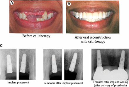 Complete oral rehabilitation. Clinical presentation of the patient prior to initiation of treatment (A) and following completed oral reconstruction (B). (C): Periapical radiographs of oral implants showing osseointegration of implants and stable bone levels at the time of placement, 6 months following placement, and 6 months following functional restoration and biomechanical loading of implants with a dental prosthesis.