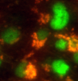 Brain tumor stem cells (orange) in mice express a stem cell marker (green). Researchers at Washington University School of Medicine in St. Louis are studying how cancer stem cells make tumors harder to kill and are looking for ways to eradicate these treatment-resistant cells. Credit: Yi-Hsien Chen 
