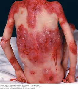 epidermolysis bullosa skin condition #11