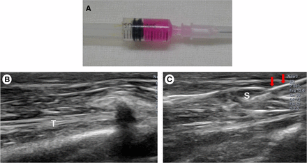 Human umbilical cord blood-derived mesenchymal stem cell (MSC) and ultrasound images. (A): Human umbilical cord blood-derived MSCs. (B): Injection was made in the left shoulder subscapularis (SCC) full-thickness tears under ultrasound guidance. (C): Longitudinal ultrasound image showed the needle (arrows) in the left shoulder SCC of the rabbit. Abbreviations: S, mesenchymal stem cell; T, tendon. 