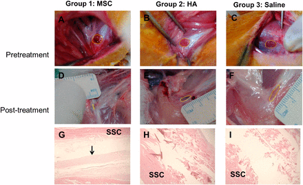 Gross morphological (A–F) and histological (G–I) findings of the subscapularis tendons in groups 1, 2, and 3. The polygon in each of the first six images depicts the area of the full-thickness subscapularis tendon tear. (A–C): Pretreatment images. (D–F): Posttreatment images. (G): Parallel arrangement of hypercellular fibroblastic bundles (arrow) was noted in group 1. (H, I): Histological findings in groups 2 and 3 showed absence of fiber bundles. Group 1 received a 0.1-ml injection of MSCs; group 2, 0.1 ml of HA; group 3, 0.1 ml of saline. Hematoxylin-and-eosin stain, ×40. Abbreviations: MSC, human umbilical cord blood-derived mesenchymal stem cell; HA, hyaluronic acid; SSC, subscapularis muscle. 