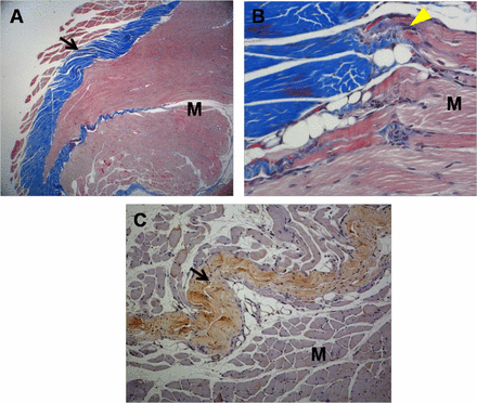 Histological micrographs of tissue from group 1 rabbits. (A): Newly regenerated tendons are shown in the blue-stained fibers (black arrow; Masson’s trichrome stain; magnification, ×12.5). (B): Regenerated tendon fibers (yellow arrowhead; Masson’s trichrome stain; magnification, ×250) are connected to adjacent M fibers. (C): The regenerated tendon fibers (black arrow) stained with anti-type 1 collagen antibody. The defect was reconstructed with human umbilical cord blood-derived mesenchymal stem cells (magnification, ×100). Abbreviation: M, muscle. 