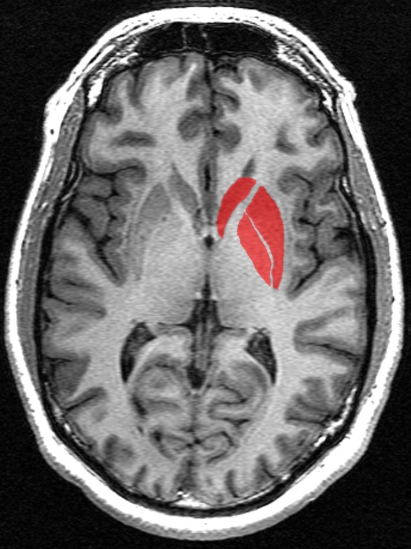 This is a transverse section of the striatum from a structural MR image. The striatum, in red, includes the caudate nucleus (top), the putamen (right), and, when including the term 'corpus' striatum, the globus pallidus (lower left).