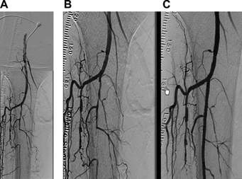 Look at the right side of these angiograms and you will see that a vessel is obstructed and blood is not flowing through it. This is an example of Critical Limb Ischemia.