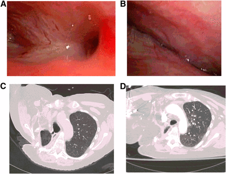 Preoperative imaging showing size and location of fistula, and postoperative imaging demonstrating disease resolution. (A): Preoperative bronchoscopy demonstrating large bronchopleural fistula (BPF) cavity and lateral extension of fistula tracts. (B): Postoperative bronchoscopy (3 months) demonstrating progressive healing of BPF site. (C): Preoperative computed tomography scan demonstrating large BPF with connection to atmosphere (additional axial slices inferiorly). (D): Postoperative computed tomography scan (16 months) demonstrating resolution of BPF. 